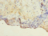 Immunohistochemistry of paraffin-embedded human breast cancer using CSB-PA023615LA01HU at dilution of 1:100