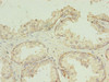 Immunohistochemistry of paraffin-embedded human prostate cancer using CSB-PA023711EA01HU at dilution of 1:100