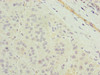 Immunohistochemistry of paraffin-embedded human liver cancer using CSB-PA023759LA01HU at dilution of 1:100