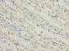 Immunohistochemistry of paraffin-embedded human gastric cancer using CSB-PA023779LA01HU at dilution of 1:100