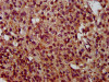 IHC image of CSB-PA023784LA01HU diluted at 1:400 and staining in paraffin-embedded human glioma performed on a Leica BondTM system. After dewaxing and hydration, antigen retrieval was mediated by high pressure in a citrate buffer (pH 6.0) . Section was blocked with 10% normal goat serum 30min at RT. Then primary antibody (1% BSA) was incubated at 4°C overnight. The primary is detected by a biotinylated secondary antibody and visualized using an HRP conjugated SP system.