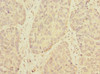 Immunohistochemistry of paraffin-embedded human ovarian cancer using CSB-PA023803LA01HU at dilution of 1:100 Immunohistochemistry of paraffin-embedded human ovarian cancer using CSB-PA023803LA01HU at dilution of 1:100