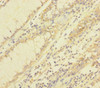 Immunohistochemistry of paraffin-embedded human colon cancer using CSB-PA025384HA01HU at dilution of 1:100