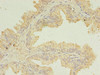 Immunohistochemistry of paraffin-embedded human prostate cancer using CSB-PA025443DA01HU at dilution of 1:100