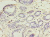 Immunohistochemistry of paraffin-embedded human breast cancer using CSB-PA025443DA01HU at dilution of 1:100