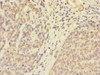 Immunohistochemistry of paraffin-embedded human ovarian cancer using CSB-PA025539LA01HU at dilution of 1:100