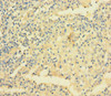 Immunohistochemistry of paraffin-embedded human lung cancer using CSB-PA025784LA01HU at dilution of 1:100
