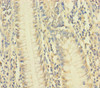 Immunohistochemistry of paraffin-embedded human colon cancer using CSB-PA025784LA01HU at dilution of 1:100