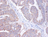 Immunohistochemistry of paraffin-embedded human colon cancer using CSB-PA02604A0Rb at dilution of 1:100