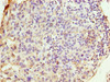 Immunohistochemistry of paraffin-embedded human bladder cancer using CSB-PA026050LA01HU at dilution of 1:100