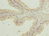 Immunohistochemistry of paraffin-embedded human prostate cancer using CSB-PA026077LA01HU at dilution of 1:100