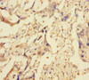 Immunohistochemistry of paraffin-embedded human pancreatic cancer using CSB-PA026193LA01HU at dilution of 1:100