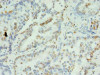 Immunohistochemistry of paraffin-embedded human lung cancer using CSB-PA026233LA01HU at dilution of 1:100