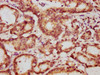 IHC image of CSB-PA026287DA01HU diluted at 1:1000 and staining in paraffin-embedded human colon cancer performed on a Leica BondTM system. After dewaxing and hydration, antigen retrieval was mediated by high pressure in a citrate buffer (pH 6.0) . Section was blocked with 10% normal goat serum 30min at RT. Then primary antibody (1% BSA) was incubated at 4°C overnight. The primary is detected by a biotinylated secondary antibody and visualized using an HRP conjugated SP system.