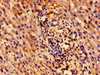 Immunohistochemistry of paraffin-embedded human liver cancer using CSB-PA026546LA01HU at dilution of 1:100