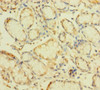 Immunohistochemistry of paraffin-embedded human gastric cancer using CSB-PA026619LA01HU at dilution of 1:100