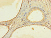 Immunohistochemistry of paraffin-embedded human prostate cancer using CSB-PA026746LA01HU at dilution of 1:100
