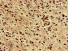 Immunohistochemistry analysis of human glioma using CSB-PA026817LA01HU at dilution of 1:100
