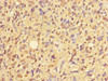Immunohistochemistry of paraffin-embedded human glioma using CSB-PA026839LA01HU at dilution of 1:100