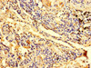 Immunohistochemistry of paraffin-embedded human lung cancer using CSB-PA026839LA01HU at dilution of 1:100