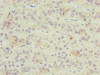 Immunohistochemistry of paraffin-embedded human liver cancer using CSB-PA026900LA01HU at dilution of 1:100 Immunohistochemistry of paraffin-embedded human liver cancer using CSB-PA026900LA01HU at dilution of 1:100