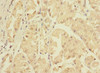 Immunohistochemistry of paraffin-embedded human gastric cancer using CSB-PA026902LA01HU at dilution of 1:100