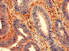 Immunohistochemistry analysis of human colon cancer using CSB-PA027047LA01HU at dilution of 1:100 Immunohistochemistry analysis of human colon cancer using CSB-PA027047LA01HU at dilution of 1:100