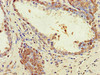 Immunohistochemistry of paraffin-embedded human prostate cancer using CSB-PA027086LA01HU at dilution of 1:100