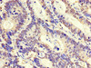 Immunohistochemistry of paraffin-embedded human colon cancer using CSB-PA027086LA01HU at dilution of 1:100
