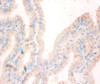 Immunohistochemistry of paraffin-embedded human bladder cancer using CSB-PA02775A0Rb at dilution of 1:50