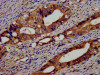 IHC image of CSB-PA03099A0Rb diluted at 1:400 and staining in paraffin-embedded human colon cancer performed on a Leica BondTM system. After dewaxing and hydration, antigen retrieval was mediated by high pressure in a citrate buffer (pH 6.0) . Section was blocked with 10% normal goat serum 30min at RT. Then primary antibody (1% BSA) was incubated at 4°C overnight. The primary is detected by a biotinylated secondary antibody and visualized using an HRP conjugated SP system.
