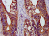 IHC image of CSB-PA03425A0Rb diluted at 1:1200 and staining in paraffin-embedded human colon cancer performed on a Leica BondTM system. After dewaxing and hydration, antigen retrieval was mediated by high pressure in a citrate buffer (pH 6.0) . Section was blocked with 10% normal goat serum 30min at RT. Then primary antibody (1% BSA) was incubated at 4°C overnight. The primary is detected by a biotinylated secondary antibody and visualized using an HRP conjugated SP system.