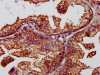 IHC image of CSB-PA03425A0Rb diluted at 1:1200 and staining in paraffin-embedded human prostate cancer performed on a Leica BondTM system. After dewaxing and hydration, antigen retrieval was mediated by high pressure in a citrate buffer (pH 6.0) . Section was blocked with 10% normal goat serum 30min at RT. Then primary antibody (1% BSA) was incubated at 4°C overnight. The primary is detected by a biotinylated secondary antibody and visualized using an HRP conjugated SP system.