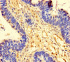 Immunohistochemistry of paraffin-embedded human ovarian cancer using CSB-PA03595A0Rb at dilution of 1:100