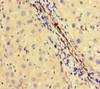 Immunohistochemistry of paraffin-embedded human liver cancer using CSB-PA03595A0Rb at dilution of 1:100