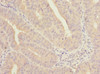 Immunohistochemistry of paraffin-embedded human endometrial cancer using CSB-PA03765A0Rb at dilution of 1:100