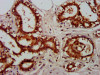 IHC image of CSB-PA03987A0Rb diluted at 1:600 and staining in paraffin-embedded human breast cancer performed on a Leica BondTM system. After dewaxing and hydration, antigen retrieval was mediated by high pressure in a citrate buffer (pH 6.0) . Section was blocked with 10% normal goat serum 30min at RT. Then primary antibody (1% BSA) was incubated at 4°C overnight. The primary is detected by a biotinylated secondary antibody and visualized using an HRP conjugated SP system.