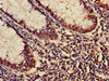 Immunohistochemistry of paraffin-embedded human colon cancer using CSB-PA04689A0Rb at dilution of 1:100