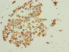Immunohistochemistry of paraffin-embedded human breast cancer using CSB-PA05095A0Rb at dilution of 1:100