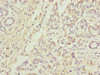 Immunohistochemistry of paraffin-embedded human pancreatic cancer using CSB-PA05104A0Rb at dilution of 1:100