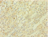 Immunohistochemistry of paraffin-embedded human breast cancer using CSB-PA05445A0Rb at dilution of 1:100