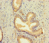 Immunohistochemistry of paraffin-embedded human prostate cancer using CSB-PA05799A0Rb at dilution of 1:100