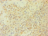 Immunohistochemistry of paraffin-embedded human breast cancer using CSB-PA05824A0Rb at dilution of 1:100