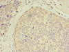 Immunohistochemistry of paraffin-embedded human gastric cancer using CSB-PA06169A0Rb at dilution of 1:100