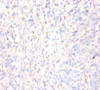 Immunohistochemistry of paraffin-embedded human gastric cancer using CSB-PA06384A0Rb at dilution of 1:50