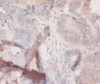 Immunohistochemistry of paraffin-embedded human colon cancer using CSB-PA06459A0Rb at dilution of 1:20