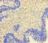 Immunohistochemistry of paraffin-embedded human ovarian cancer using CSB-PA06475A0Rb at dilution of 1:100