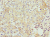 Immunohistochemistry of paraffin-embedded human liver cancer using CSB-PA06515A0Rb at dilution of 1:100