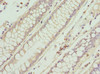 Immunohistochemistry of paraffin-embedded human colon cancer using CSB-PA06515A0Rb at dilution of 1:100