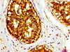 IHC image of CSB-PA06867A0Rb diluted at 1:400 and staining in paraffin-embedded human breast cancer performed on a Leica BondTM system. After dewaxing and hydration, antigen retrieval was mediated by high pressure in a citrate buffer (pH 6.0) . Section was blocked with 10% normal goat serum 30min at RT. Then primary antibody (1% BSA) was incubated at 4°C overnight. The primary is detected by a biotinylated secondary antibody and visualized using an HRP conjugated SP system.